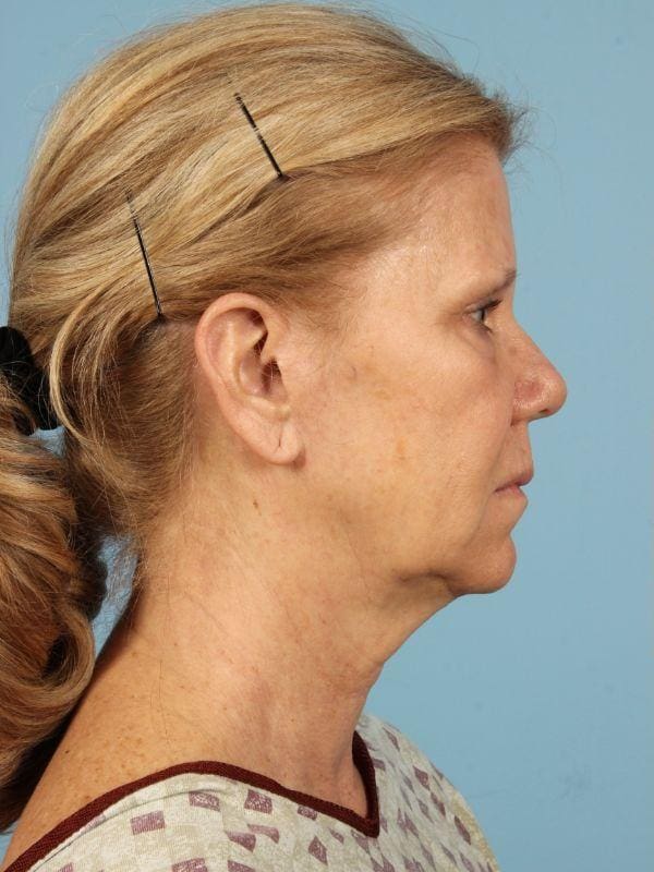 Facelift Patient Photo - Case 15498 - before view-2