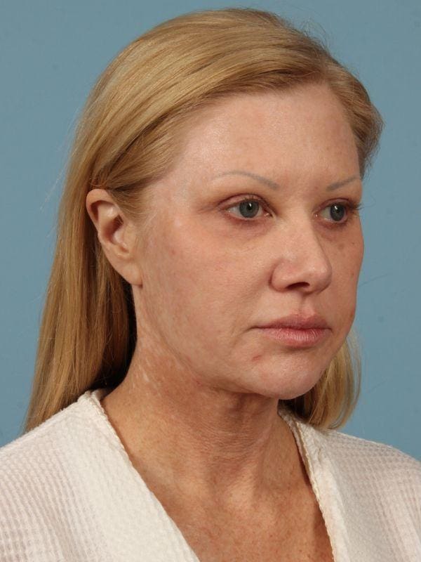 Facelift Patient Photo - Case 15510 - before view-4
