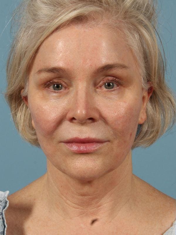 Facelift Patient Photo - Case 15523 - before view-
