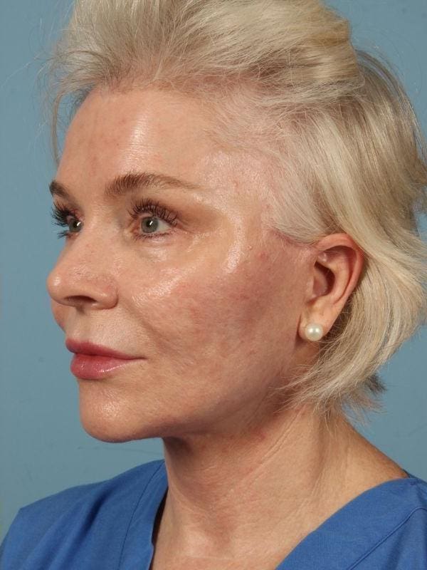 Facelift Patient Photo - Case 15523 - after view-2