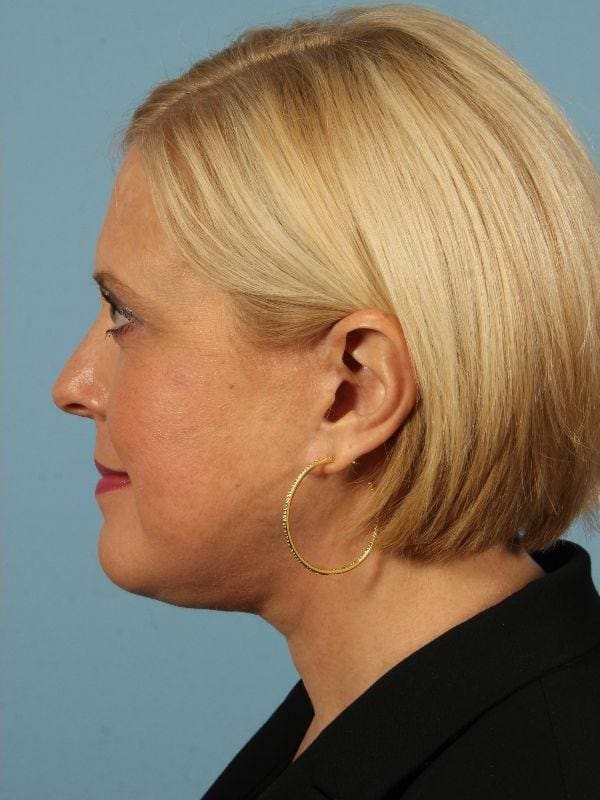 Facelift Patient Photo - Case 15533 - after view-1