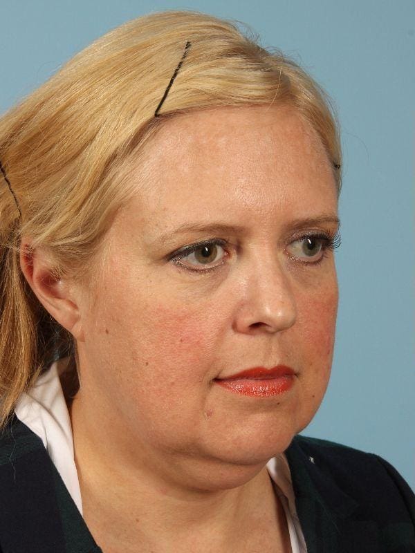 Facelift Patient Photo - Case 15533 - before view-4