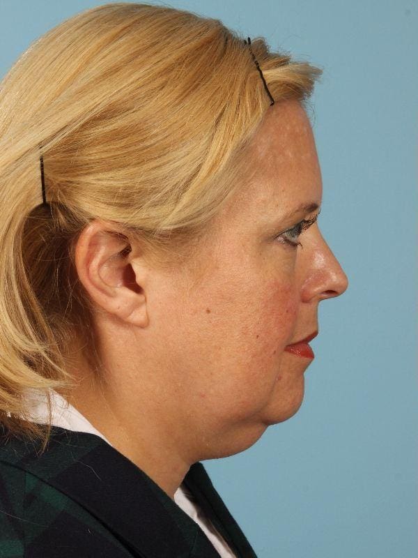 Facelift Patient Photo - Case 15533 - before view-2