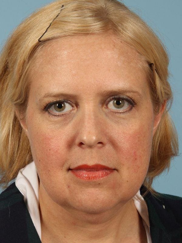 Facelift Patient Photo - Case 15533 - before view-