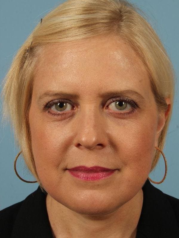 Facelift Patient Photo - Case 15533 - after view