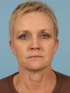 Facelift - Case 15545 - Before