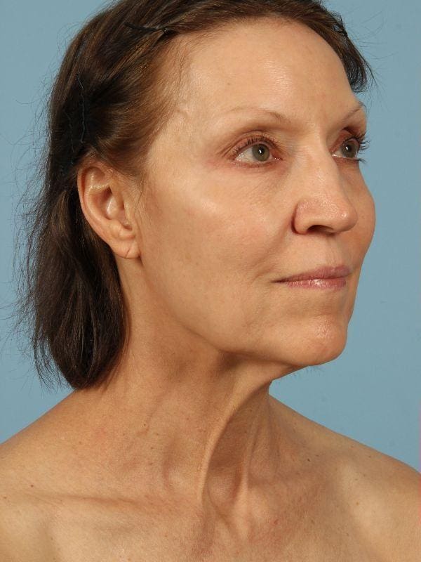 Facelift Patient Photo - Case 15558 - before view-4