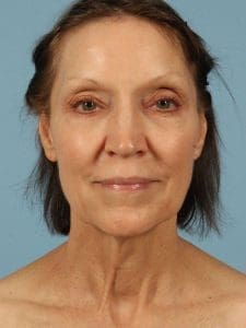 Facelift - Case 15558 - Before