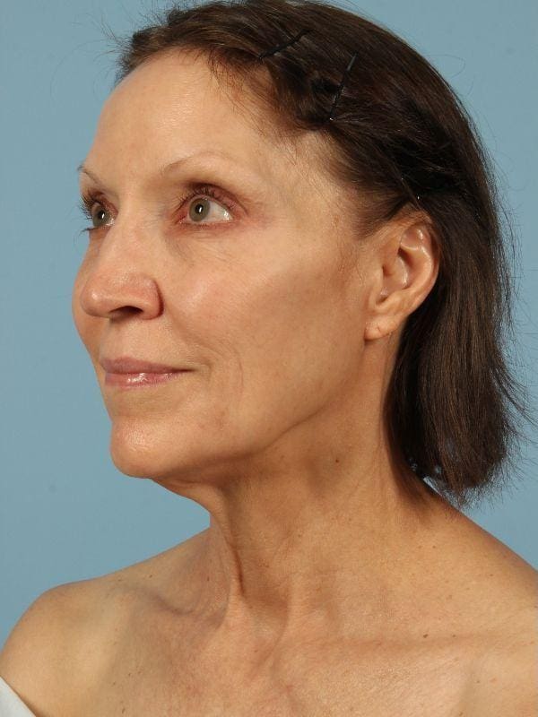 Facelift Patient Photo - Case 15558 - before view-3