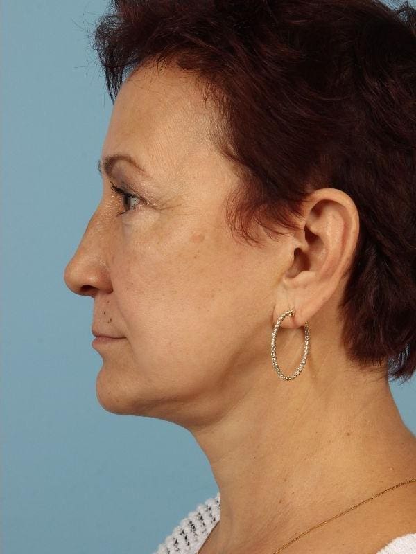 Facelift Patient Photo - Case 15582 - after view-1