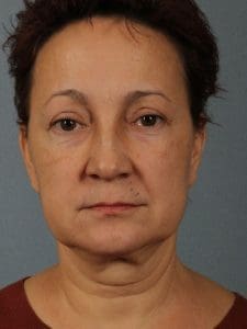 Facelift - Case 15582 - Before