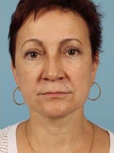 Facelift - Case 15582 - After