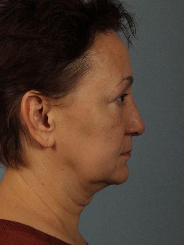 Facelift Patient Photo - Case 15582 - before view-2