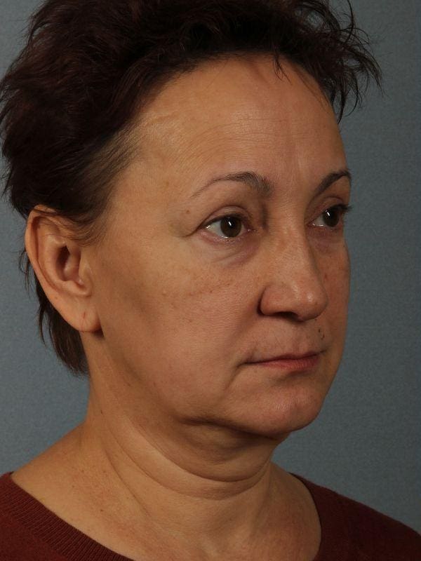 Facelift Patient Photo - Case 15582 - before view-4