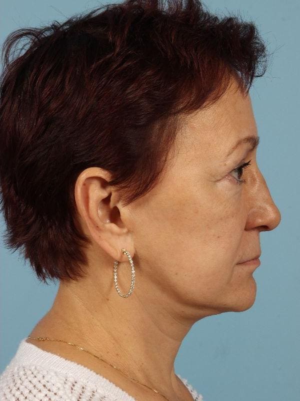 Facelift Patient Photo - Case 15582 - after view-2