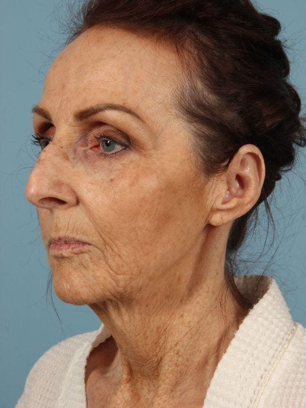 Facelift Patient Photo - Case 15595 - before view-3