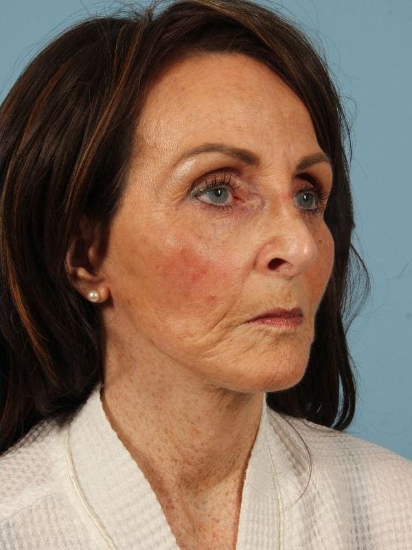 Facelift Patient Photo - Case 15595 - after view-4