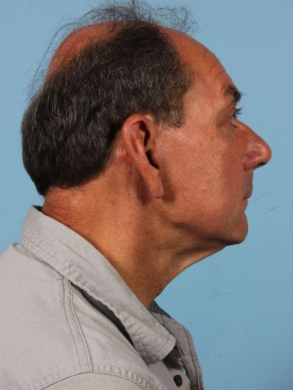 Facelift Patient Photo - Case 15619 - after view-2