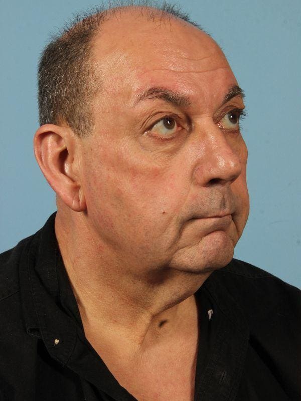 Facelift Patient Photo - Case 15619 - before view-4