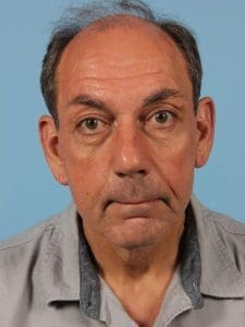 Facelift - Case 15619 - After