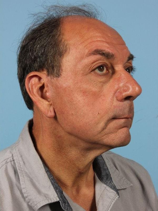 Facelift Patient Photo - Case 15619 - after view-4