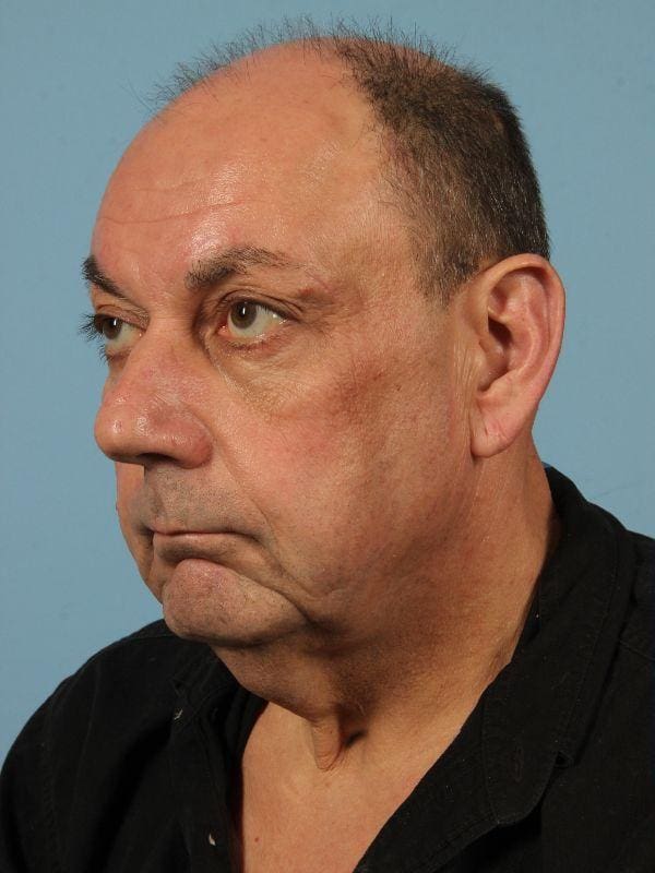 Facelift Patient Photo - Case 15619 - before view-3