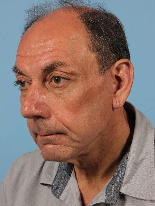 Facelift Patient Photo - Case 15619 - after view-3