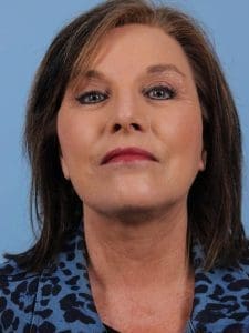 Facelift - Case 15632 - After