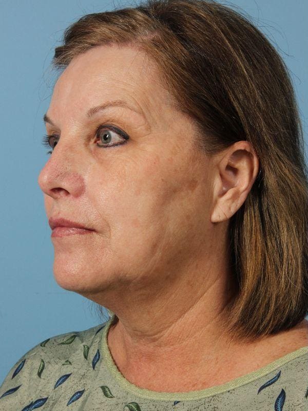 Facelift Patient Photo - Case 15632 - before view-3
