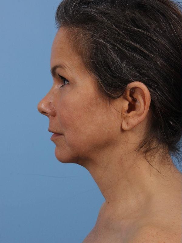 Facelift Patient Photo - Case 15644 - before view-1