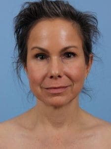 Facelift - Case 15644 - Before