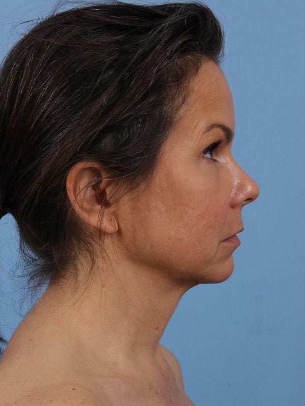 Facelift Patient Photo - Case 15644 - before view-2