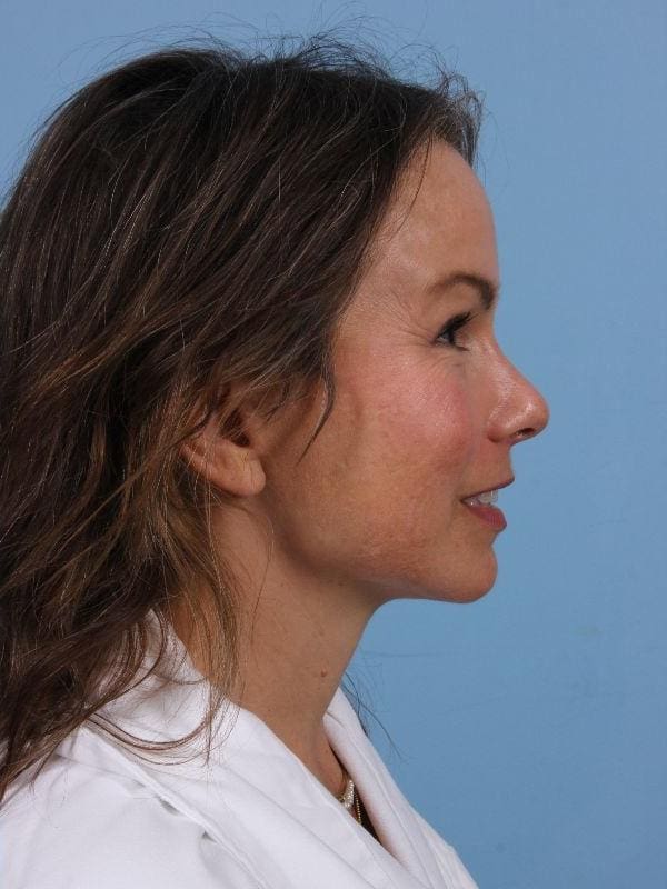 Facelift Patient Photo - Case 15644 - after view-2