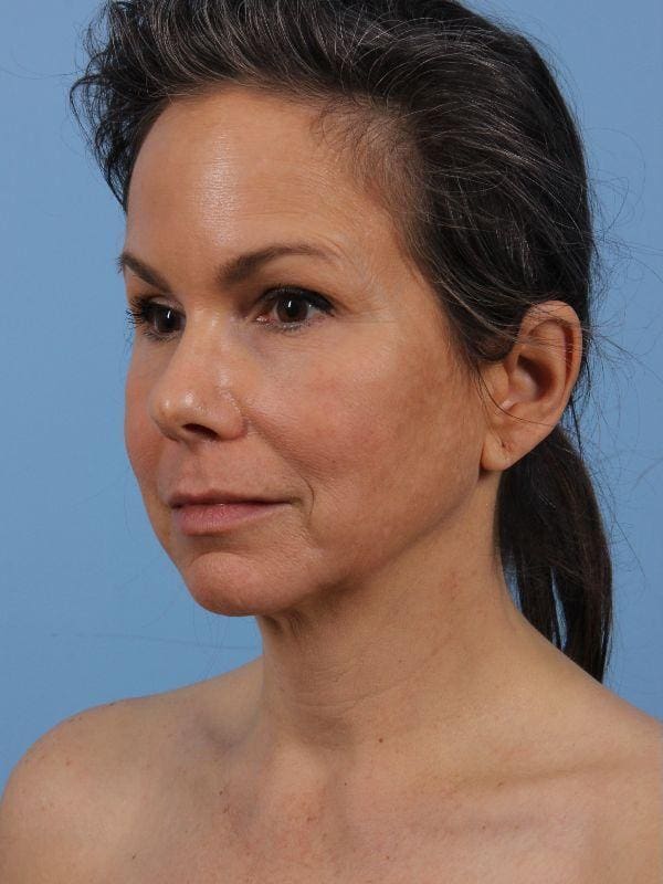 Facelift Patient Photo - Case 15644 - before view-3