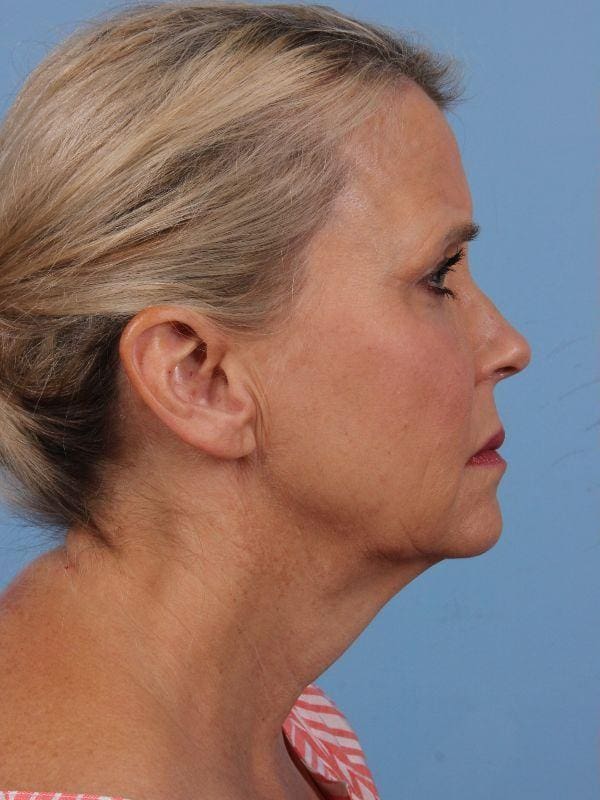 Facelift Patient Photo - Case 15656 - before view-2