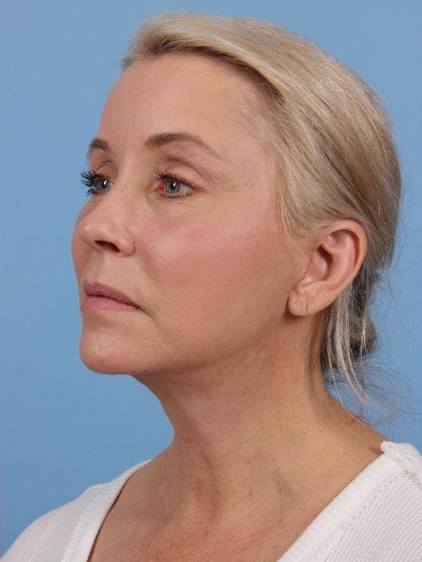Facelift Patient Photo - Case 15656 - after view-3