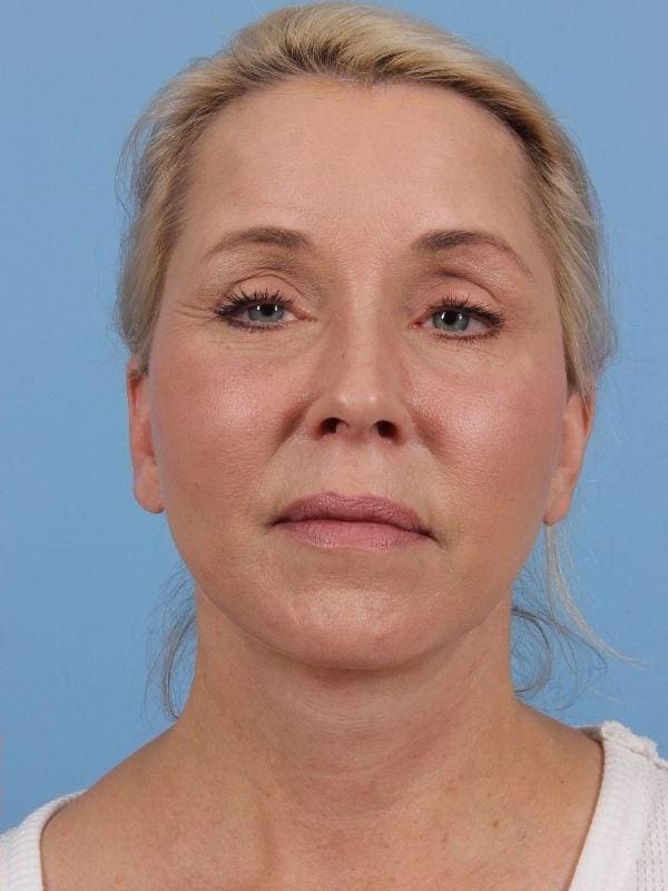 Facelift Patient Photo - Case 15656 - after view