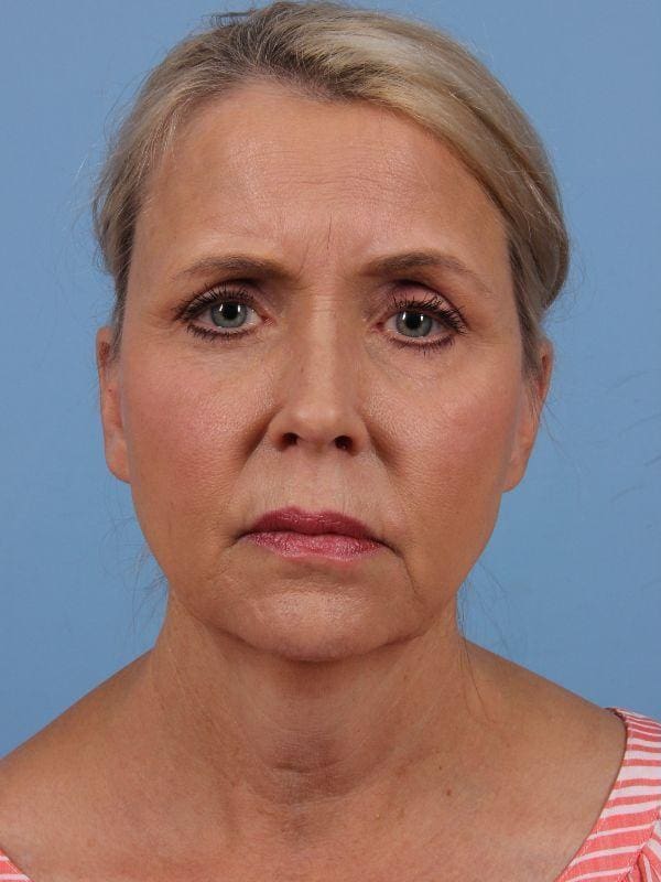 Facelift Patient Photo - Case 15656 - before view-