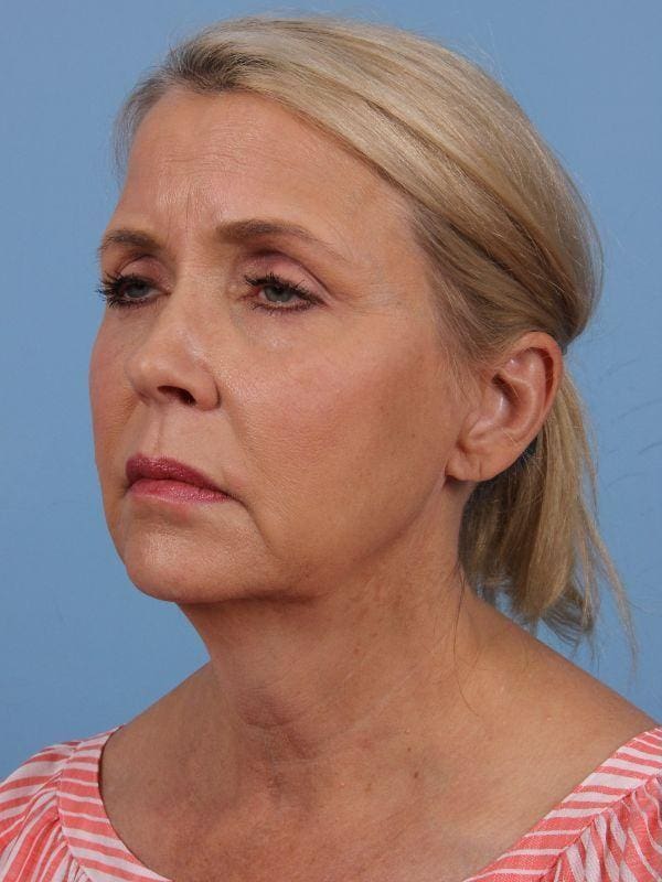 Facelift Patient Photo - Case 15656 - before view-3