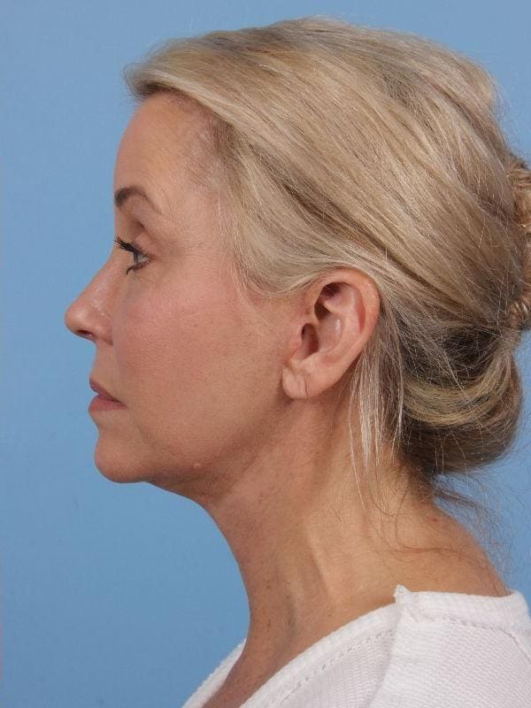 Facelift Patient Photo - Case 15656 - after view-1