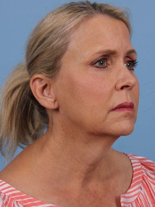 Facelift Patient Photo - Case 15656 - before view-4