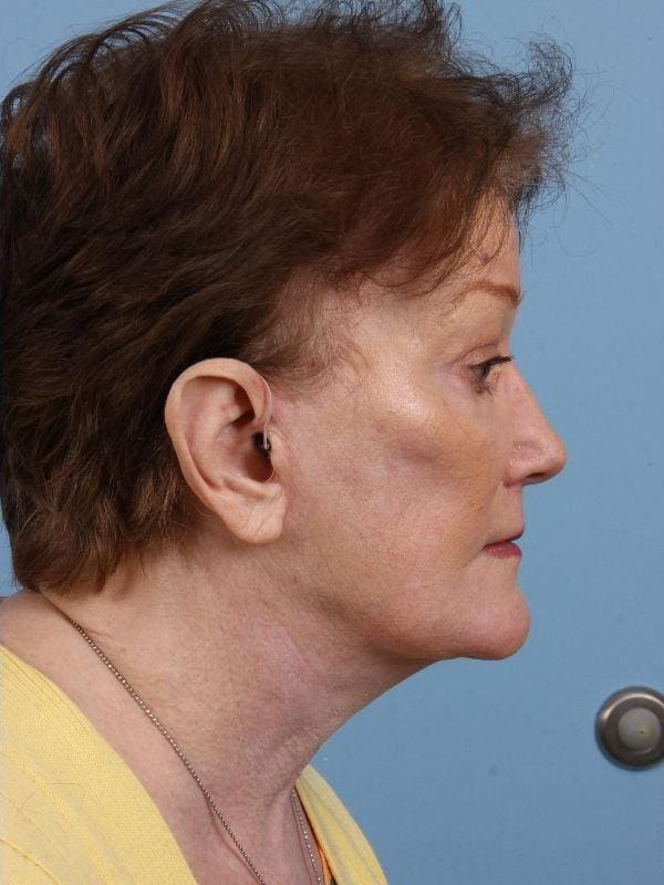Facelift Patient Photo - Case 15668 - after view-2