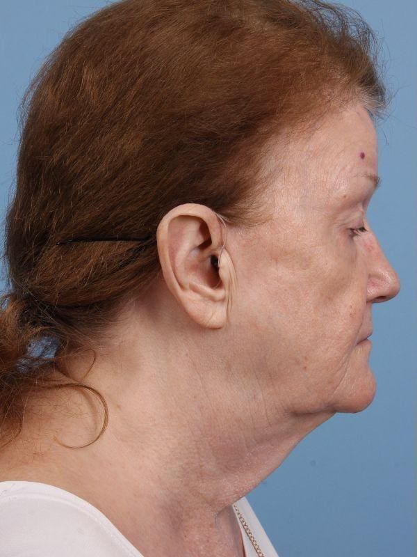 Facelift Patient Photo - Case 15668 - before view-2