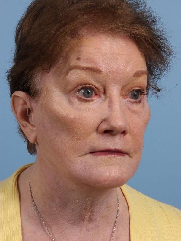 Facelift Patient Photo - Case 15668 - after view-4