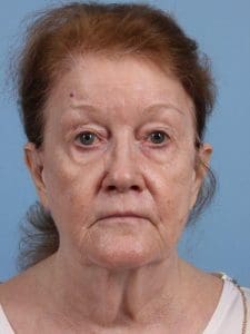 Facelift - Case 15668 - Before