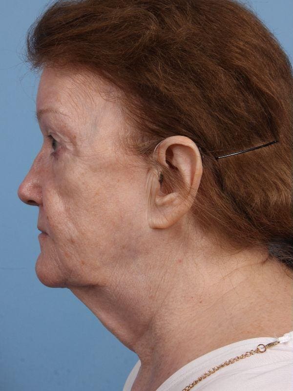 Facelift Patient Photo - Case 15668 - before view-1