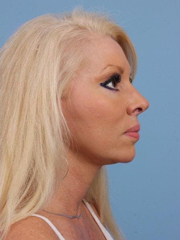 Facelift Patient Photo - Case 15680 - after view-2