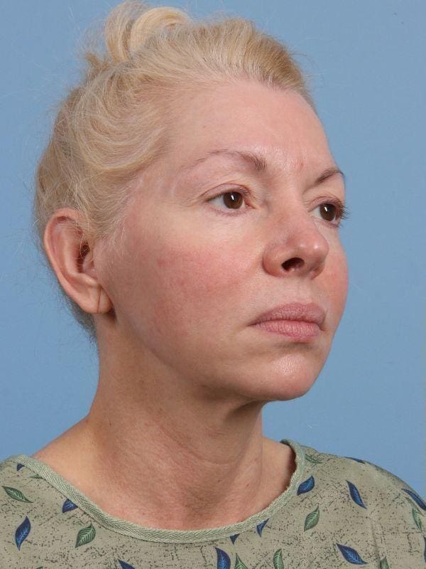 Facelift Patient Photo - Case 15680 - before view-4