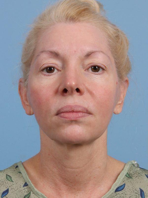 Facelift Patient Photo - Case 15680 - before view-