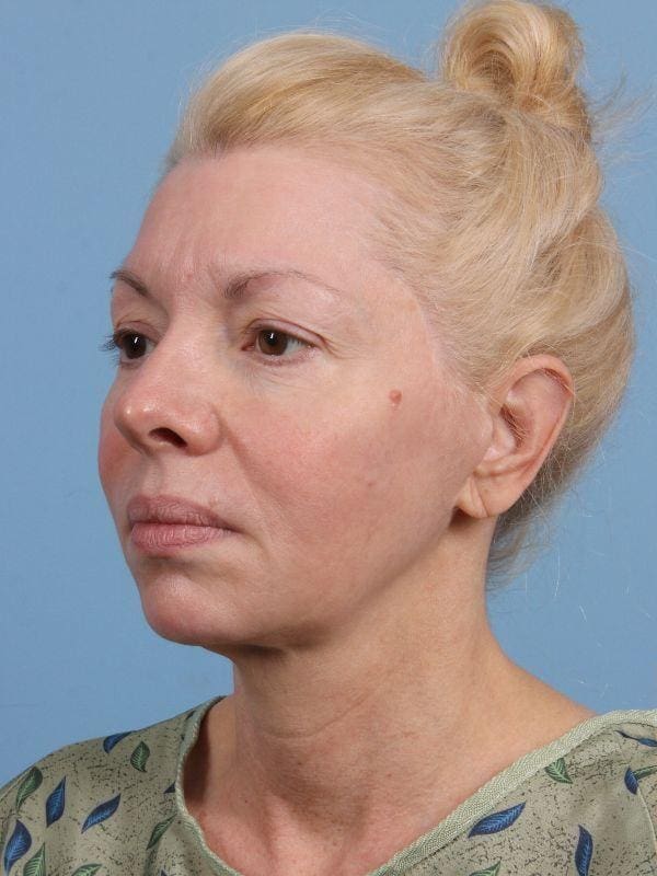 Facelift Patient Photo - Case 15680 - before view-3